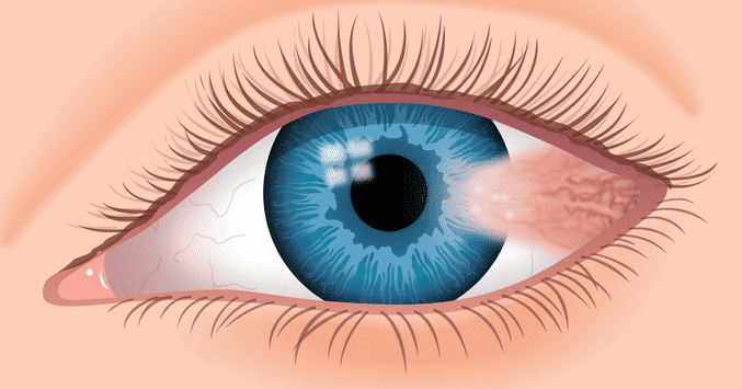 Operación de carnosidad en los ojos: Conoce los avances tecnológicos | operacion de carnosidad