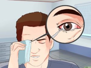 Cuerpo Extraño en el Ojo : ¿Qué hacer? | cuerpo extraño