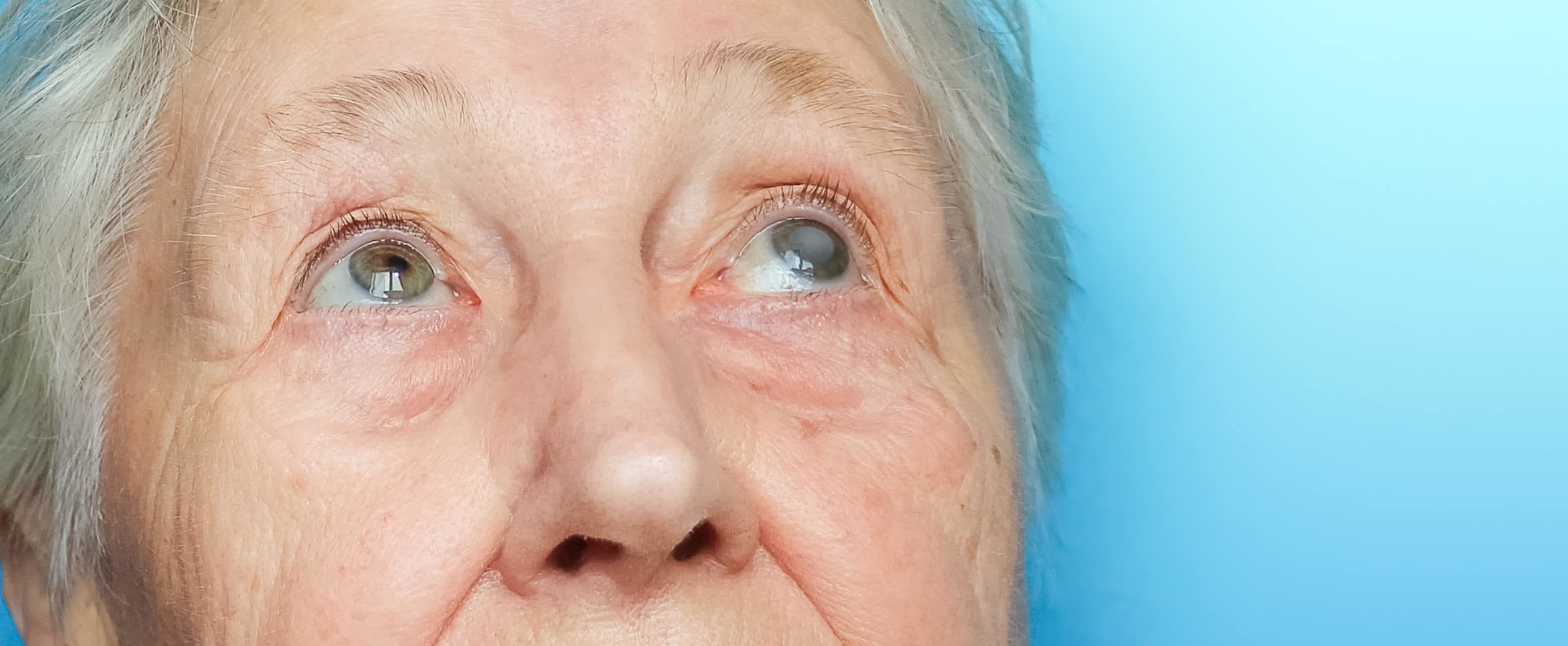 Queratitis Qu Es Y C mo Se Trata Blog De OftalmoSalud Queratitis Qu Es Y C mo Se Trata Blog De OftalmoSalud