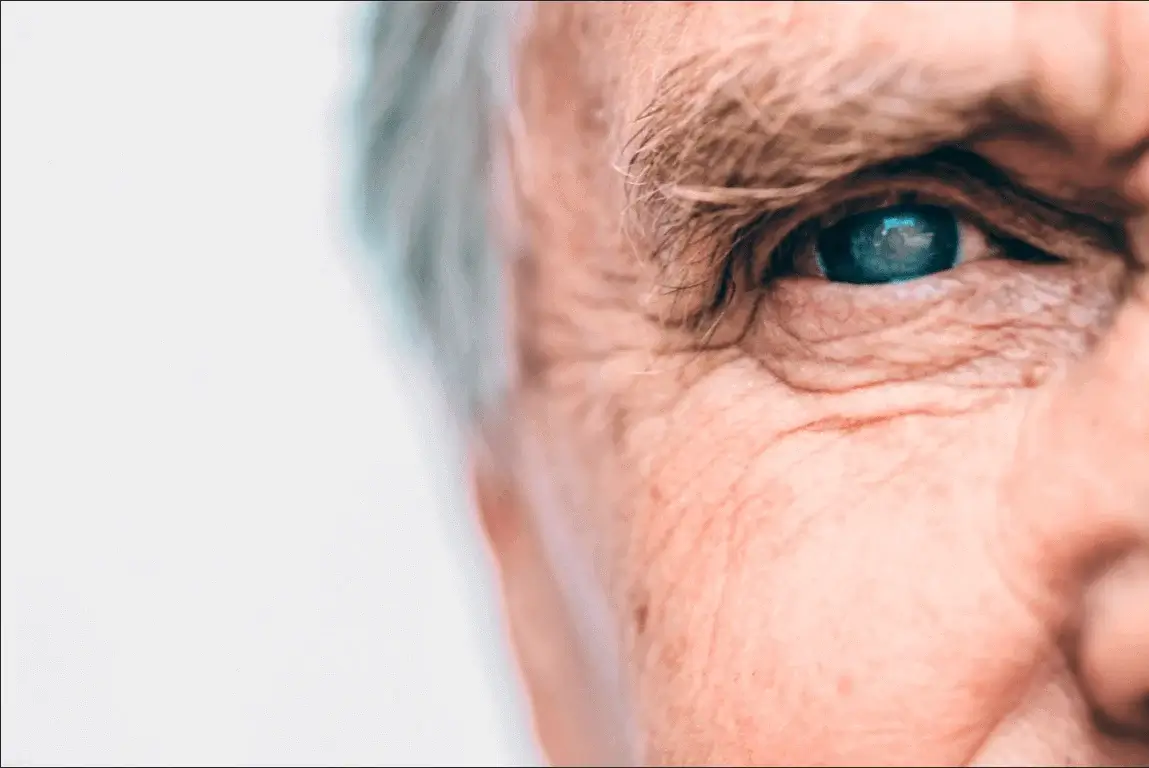 ojo-con-cataratas-persona-con-cataratas-en-los-ojos-sintomas-y-tratamiento-de-cataratas-en-los-ojo-oftamosalud
