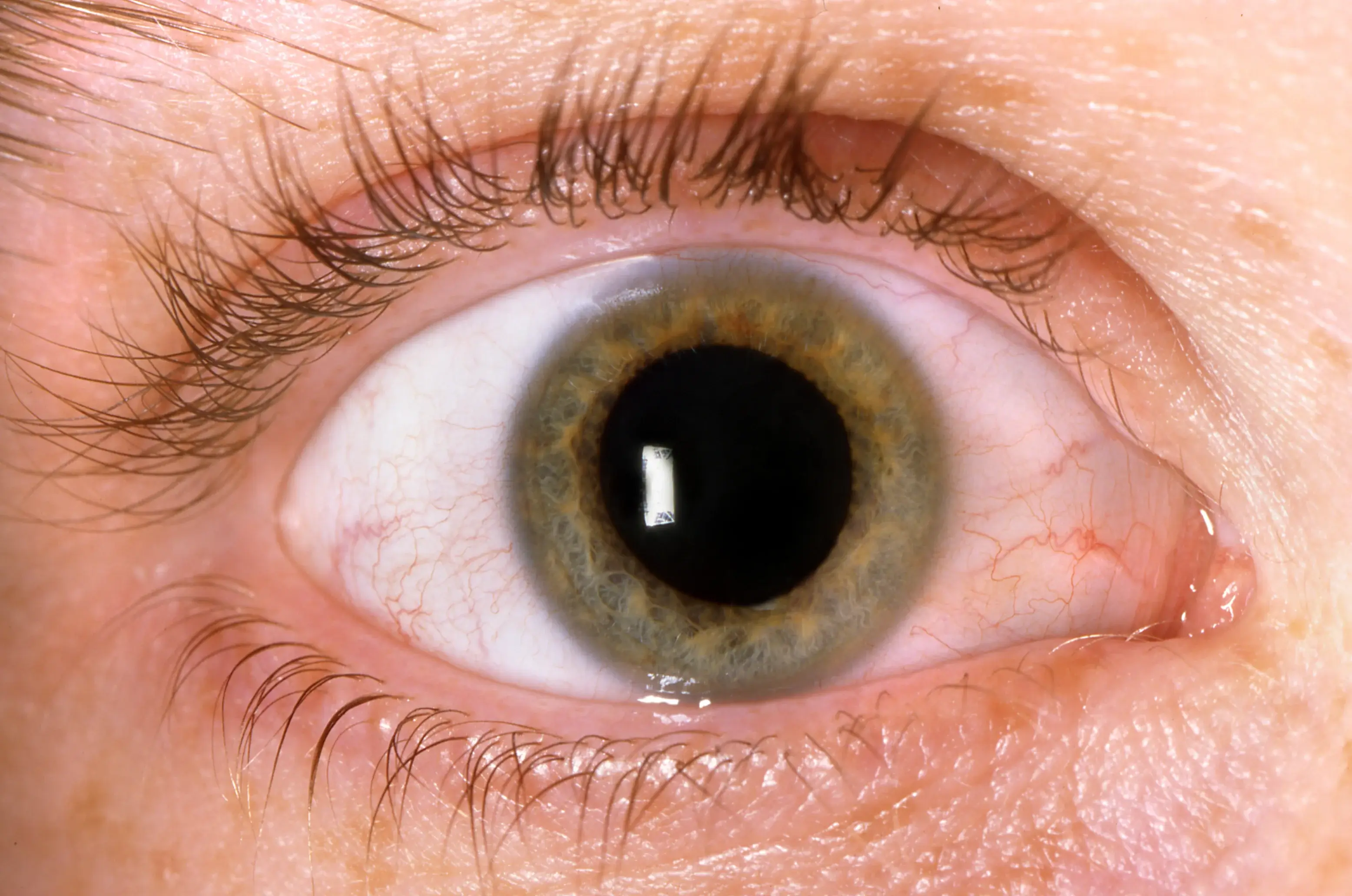 ojo-con-retinopatia-diabetica-sintomas-de-retinopatia-diabetica-oftalmosalud