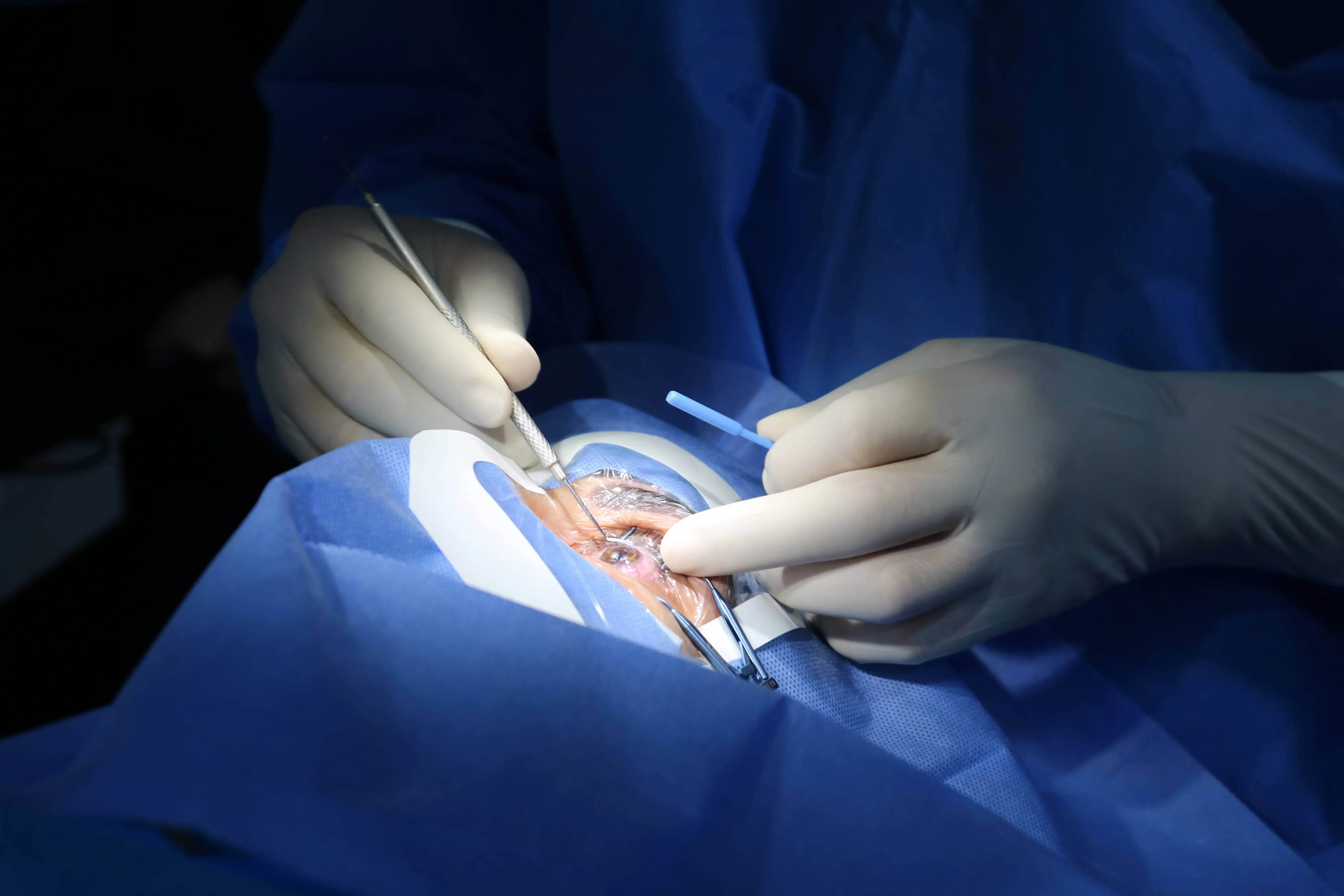 trasplante-de-cornea-medico-realizando-cirugia-de-trasplante-de-cornea-oftalmosalud